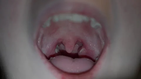 Inflamed Tonsils With Visible Pus Inside Teenage Mouth, Close-up Stock Footage 324043366