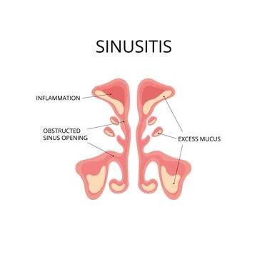 Inflammated sinus with excess mucus and obstrusted sinus openings Stock Illustration