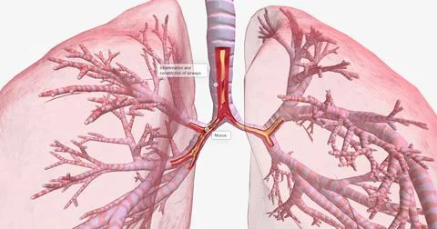 Inflammation and constriction of airways Stock Illustration