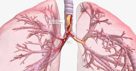 Inflammation and constriction of airways Stock Illustration
