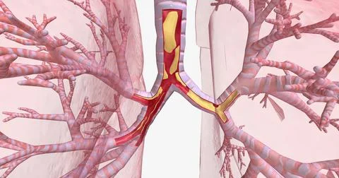 Inflammation and constriction of airways Stock Illustration