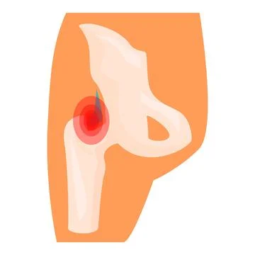 Inflammation causing pain in human hip joint Stock Illustration