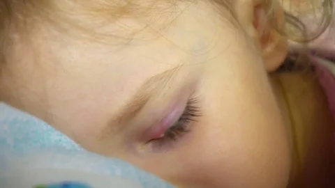 Inflammation of the eye Stock Footage 81888839