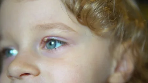 Inflammation of the eye 库存影片 81889858
