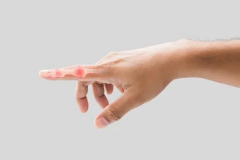 Inflammation of Forefinger bone. Stock Photos