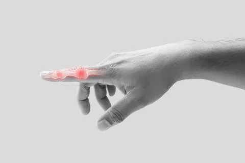 Inflammation of Forefinger bone. Stock Photos