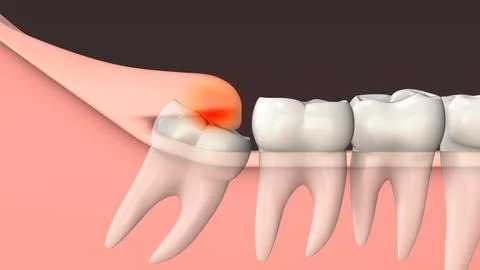 Inflammation of the gums due to an unerupted molar Ilustración de archivo