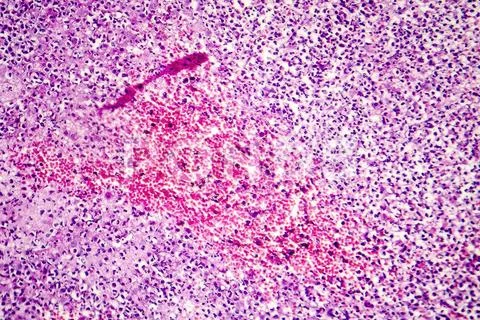 Inflammation, light micrograph showing different inflammatory cells ...