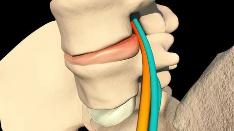 Inflammation of the Sciatic Nerve Illustrazione stock