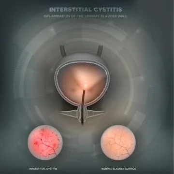 Inflammation of the urinary bladder Stock Illustration