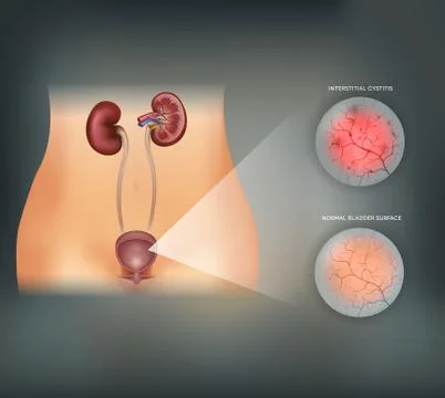 Inflammation of the urinary bladder Stock Illustration