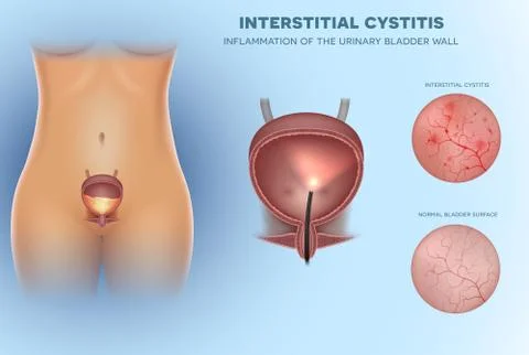 Inflammation of the urinary bladder Stock Illustration