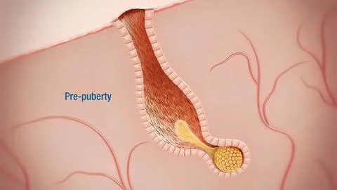 Inflammatory acne occurs when bacteria infect clogged or closed pores イラスト素材