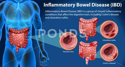 Inflammatory Bowel Disease (IBD) Infographic Illustration #235268468