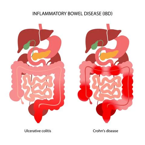 Inflammatory bowel disease Stock-Illustration