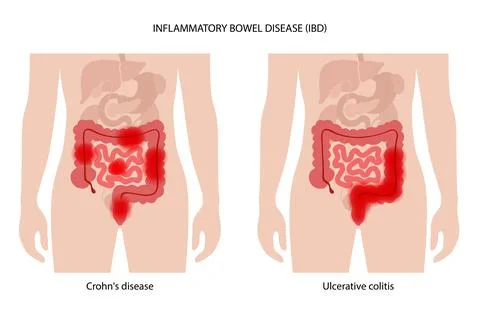 Inflammatory bowel disease Stock-Illustration