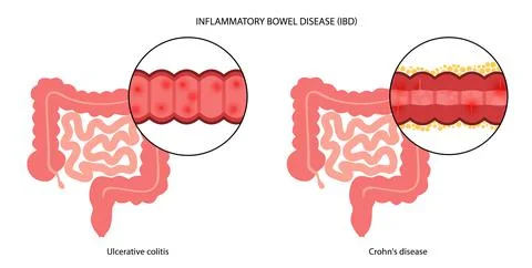 Inflammatory bowel disease Stock-Illustration