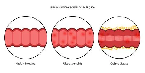 Inflammatory bowel disease Stock-Illustration