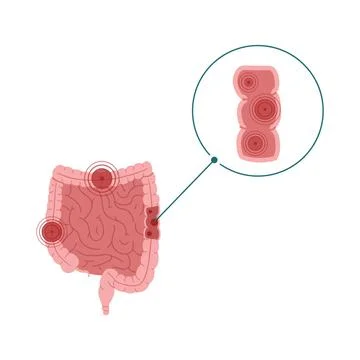  Inflammatory bowel disease vector illustration isolated on white backgrou... Stock Photos