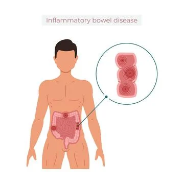  Inflammatory bowel disease vector illustration isolated on white backgrou... Stock Photos