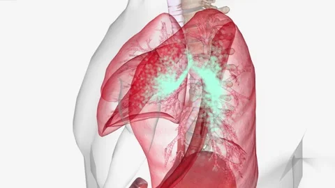 Inflammatory reaction called cold, rhinovirus and especially in areas such as Stock Footage 244669339