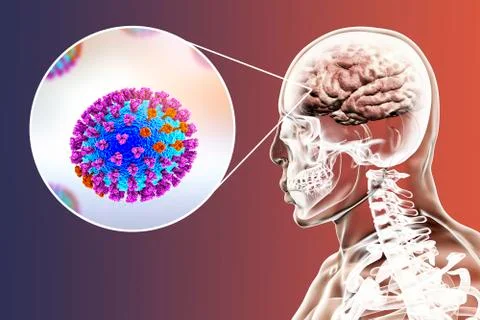 Influenza complication encephalitis Stock Illustration