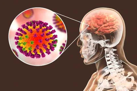 Influenza complication encephalitis Stock Illustration