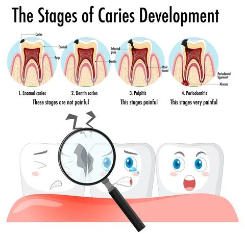 Infographic of human in stages of caries development Stock Illustration