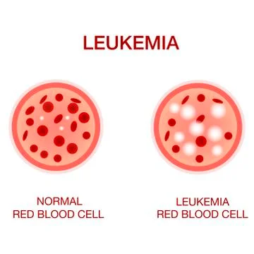 Infographic image of leukemia. Leukaemia disease awareness.Realistic vector Stock Illustration