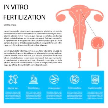 Infographic in vitro fertilization Stock Illustration