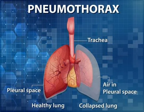 Informative illustration of Pneumothorax Stock Illustration