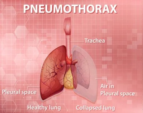 Informative illustration of Pneumothorax Stock Illustration