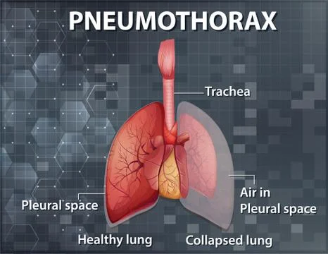 Informative illustration of Pneumothorax Stock Illustration