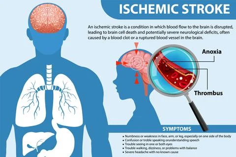 Informative poster of Ischemic stroke Stock Illustration