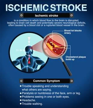 Informative poster of Ischemic stroke Stock Illustration
