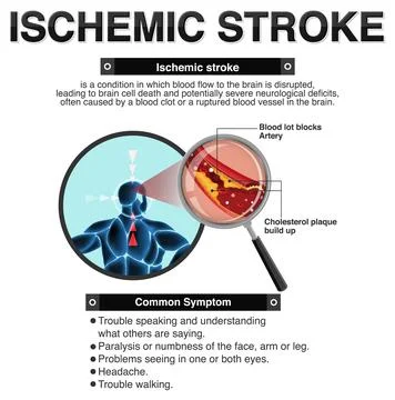 Informative poster of Ischemic stroke Stock Illustration