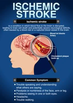 Informative poster of Ischemic stroke Stock Illustration