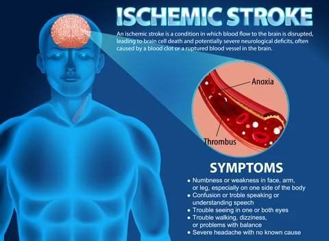 Informative poster of Ischemic stroke Stock Illustration