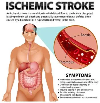 Informative poster of Ischemic stroke Stock Illustration