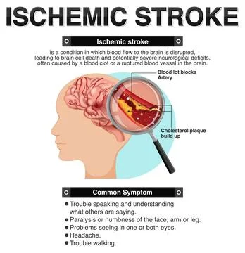 Informative poster of Ischemic stroke Stock Illustration