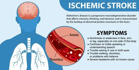 Informative poster of Ischemic stroke Stock Illustration