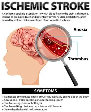 Informative poster of Ischemic stroke Stock Illustration
