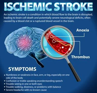 Informative poster of Ischemic stroke Stock Illustration