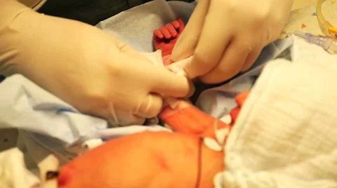 Infusion in an incubator. The real thing Stock Footage 56400714