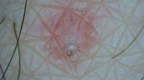 Ingrown Hairs at the microscope Stock Photos