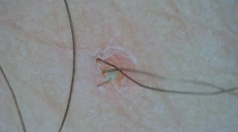 Ingrown Hairs at the microscope Stock Photos
