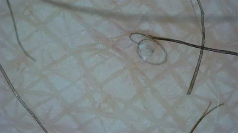 Ingrown Hairs at the microscope Stock Photos