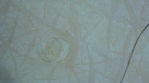 Ingrown Hairs at the microscope Stock Photos