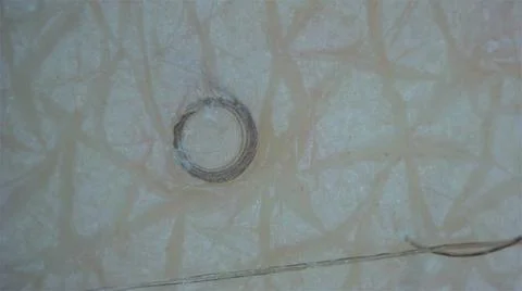 Ingrown Hairs at the microscope Stock Photos