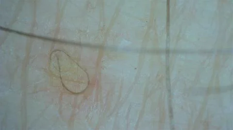 Ingrown Hairs at the microscope Stock Photos